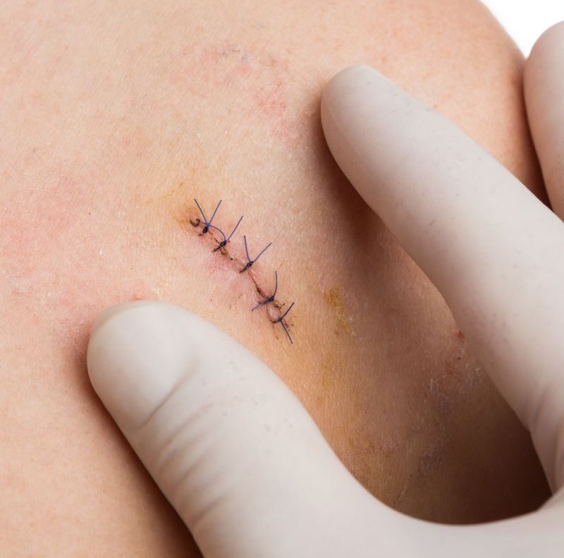 Stitches on a person's shoulder